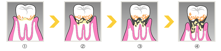 歯槽膿漏（歯周病）の進行過程